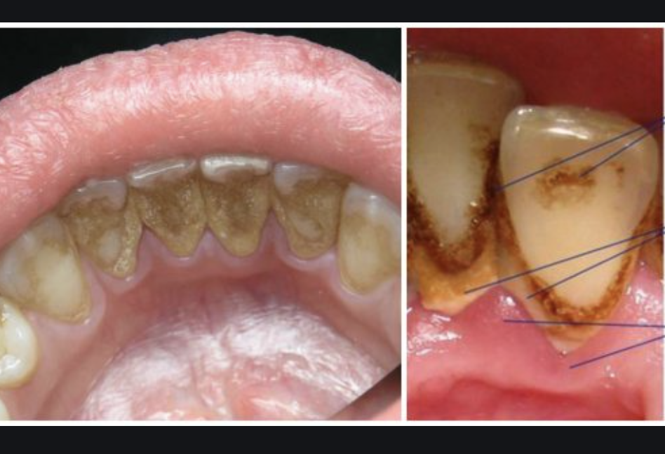 Ми всі ненавидимо зубний камінь. І всі ненавидимо бувати у стоматолога. Ось вам простий рецепт, який допоможе зберегти зуби і легко впоратися з такою проблемою, як зубний камінь.