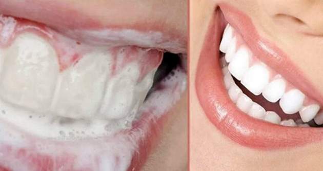 Хто ж не хоче мати білосніжні зубки! Для мене це неймовірна знахідка! Рецепт, як за кілька днів прибрати зубні камені!